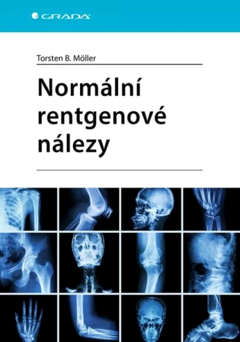 Levně Normální rentgenové nálezy (Torsten Möller,, 2024)