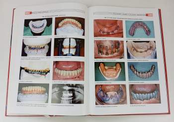 Antonín Šimůnek: Dentální implantologie