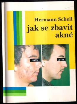 Jak se zbavit akné