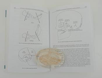John E Upledger: Kraniosakrální terapie
