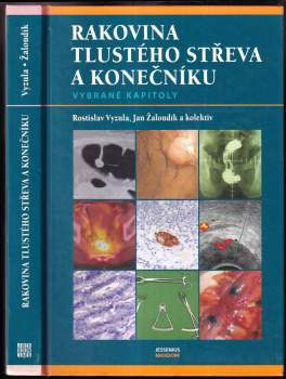 Rakovina tlustého střeva a konečníku