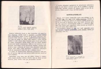 Leon Sazama: Resekce kořenových hrotů